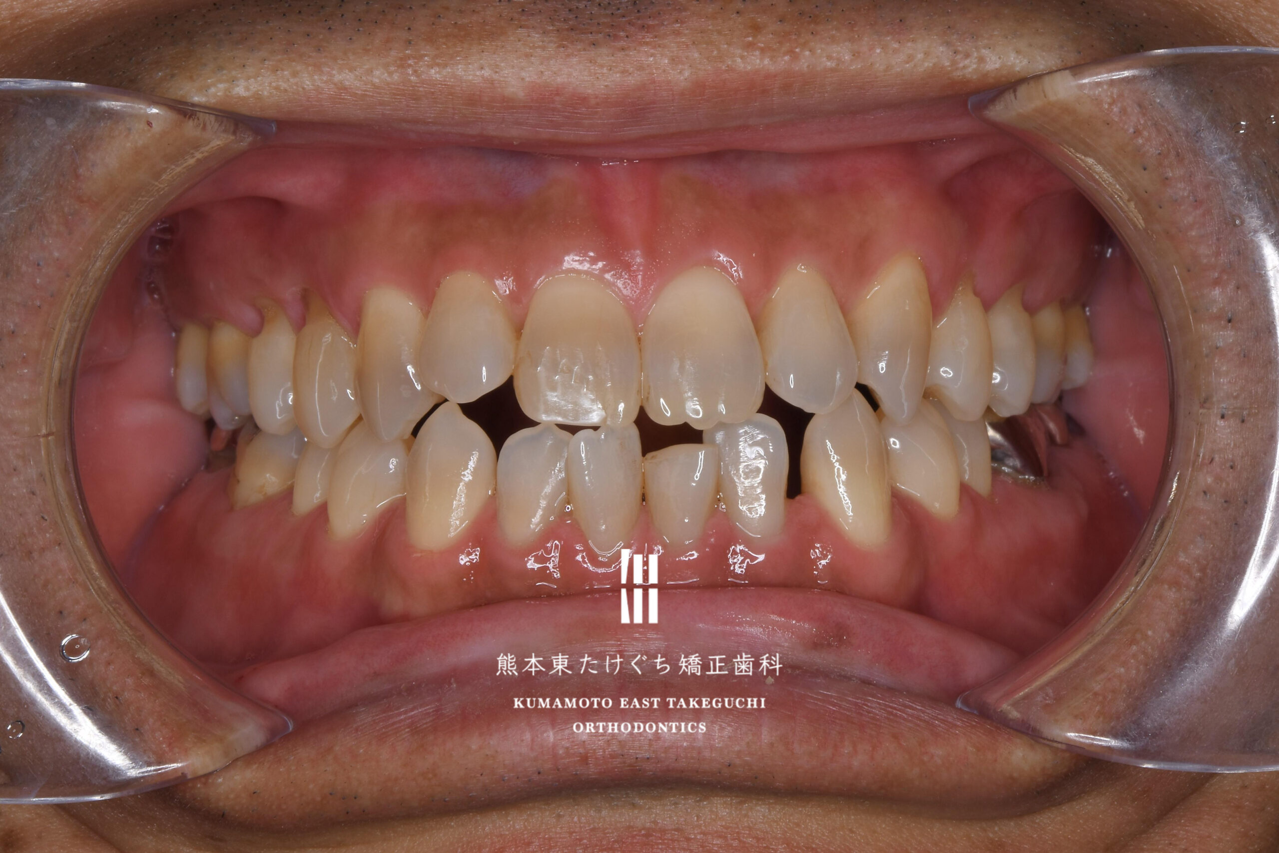 治療前