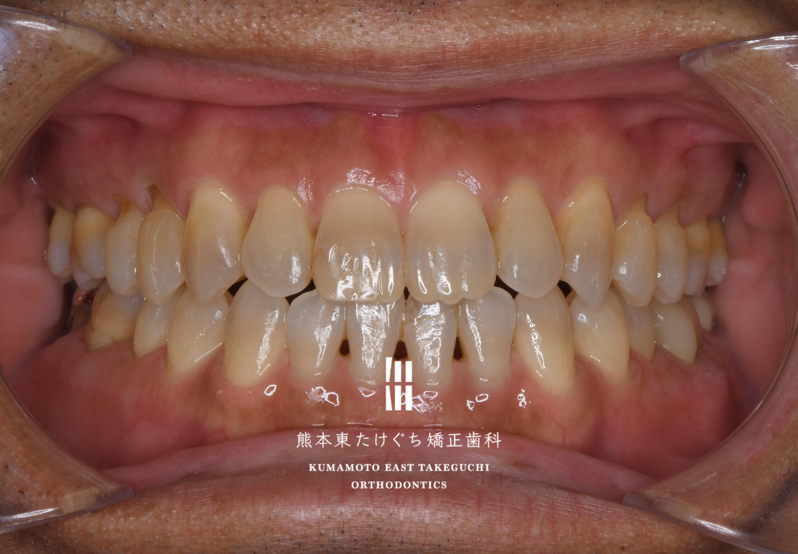 治療後