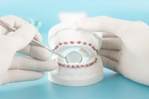 八重歯矯正の治療法