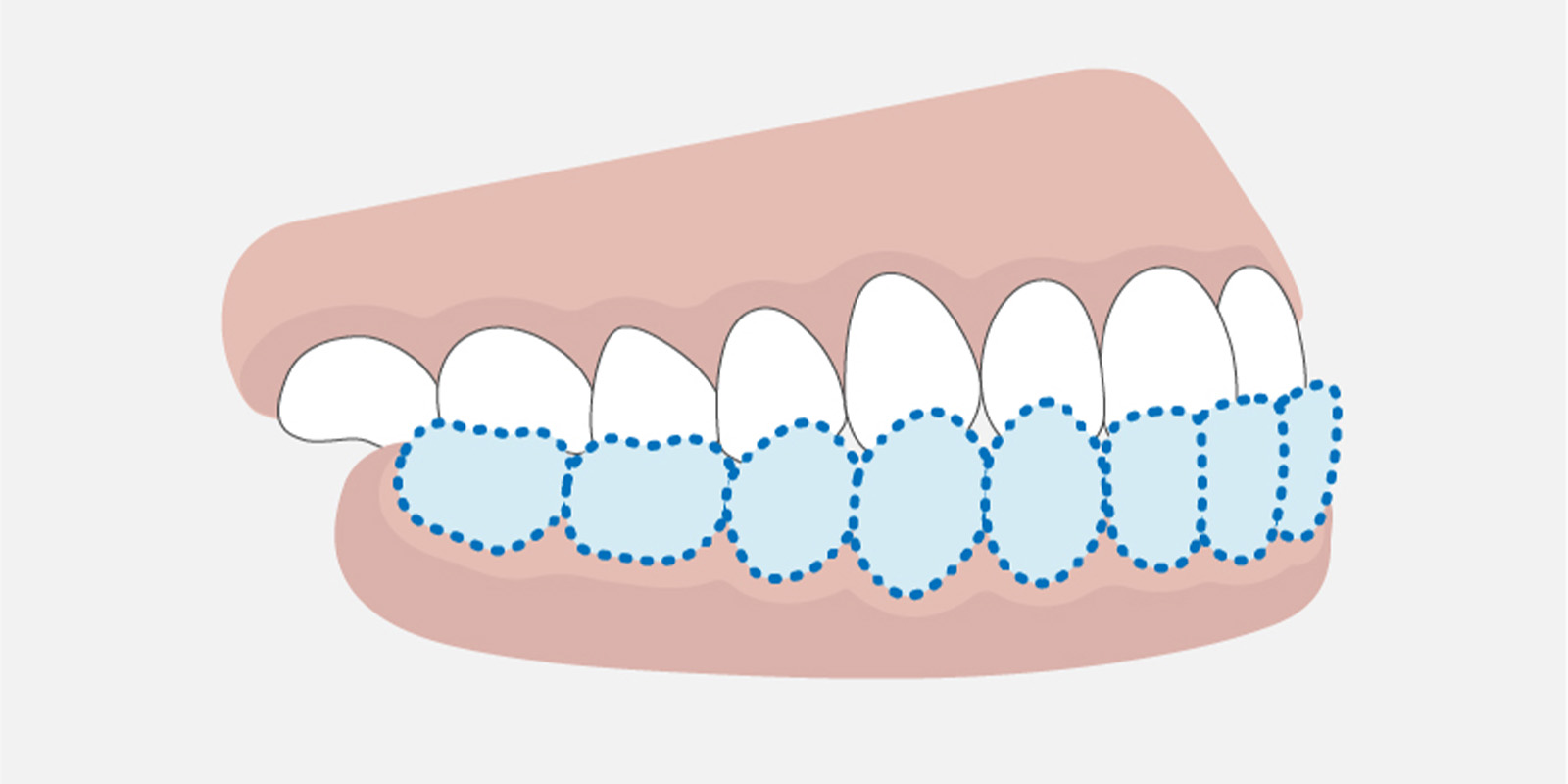 大人でも受け口は矯正で治せる？