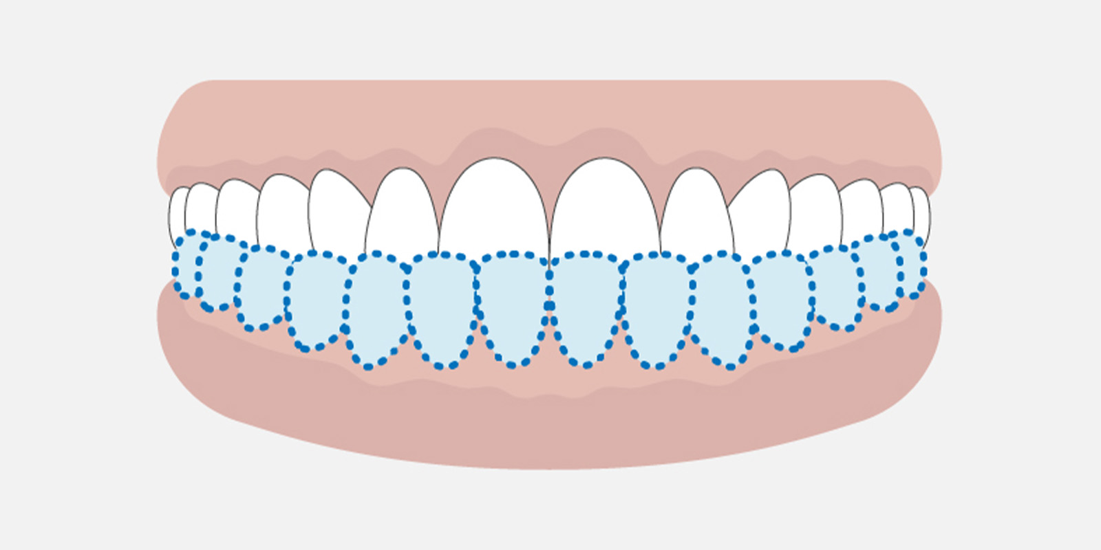 受け口（反対咬合）とは？原因と特徴