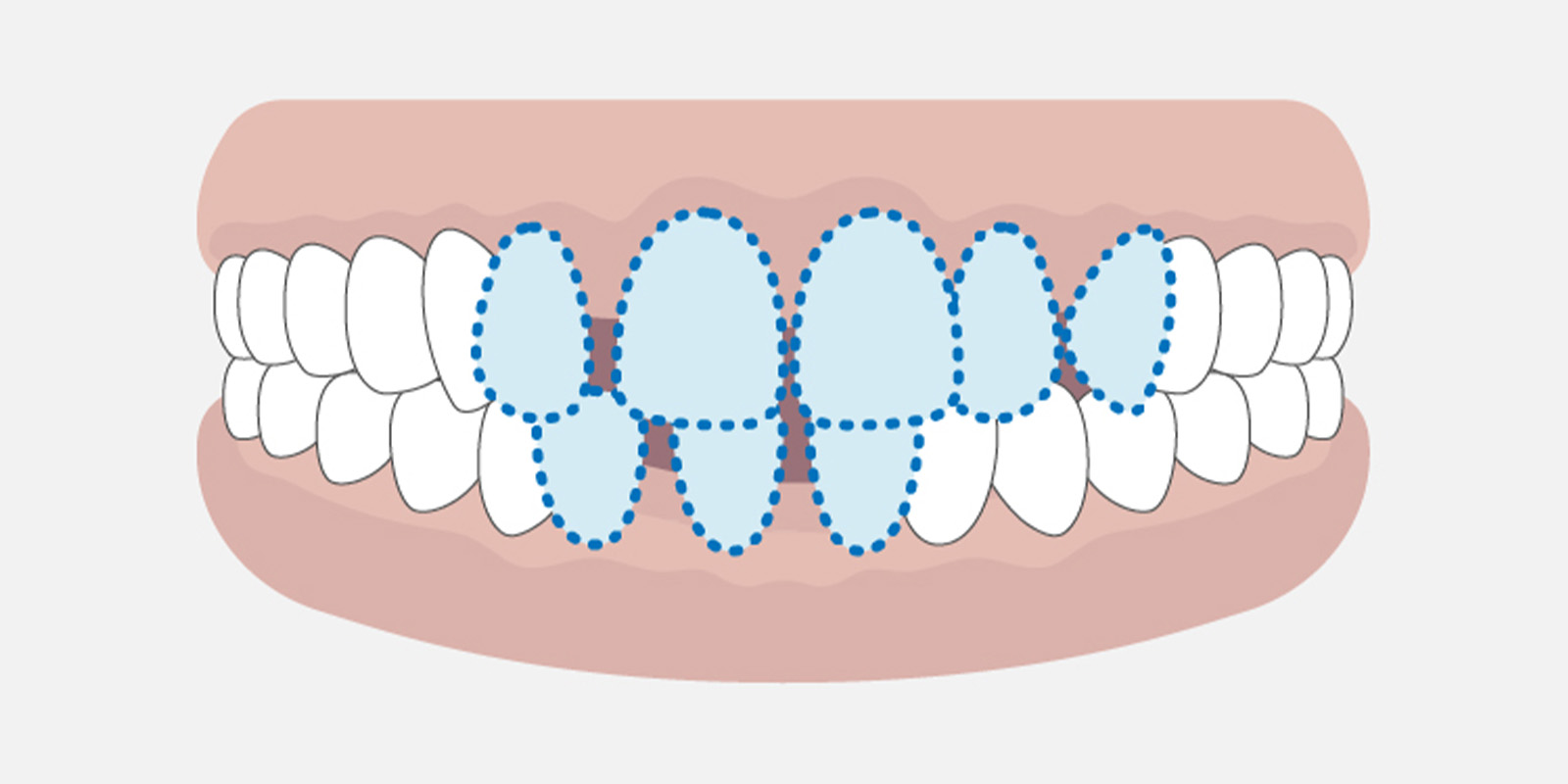 すきっ歯について