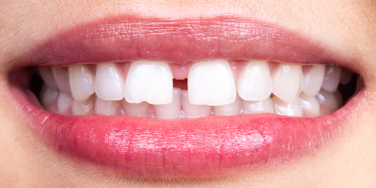 すきっ歯の治療について