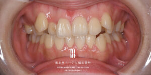 部分矯正で八重歯だけを治せる？