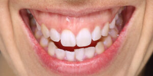 ガミースマイルは矯正で治せる？