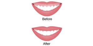 ガミースマイルの主な原因