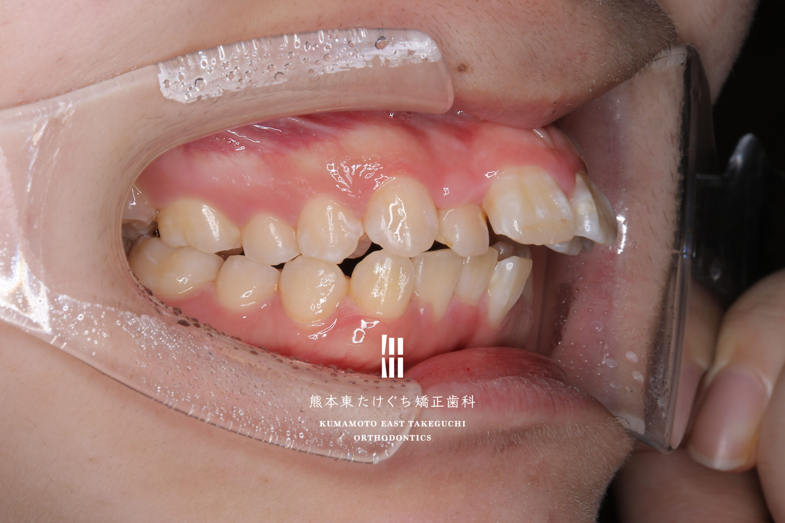 治療前